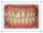審美歯科治療前