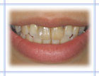 審美歯科治療前