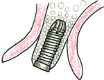 インプラント埋入
