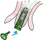 インプラント埋入