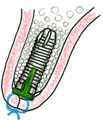 インプラント埋入
